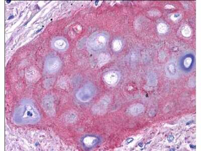 Immunohistochemistry: Collagen II Antibody [Biotin] [NBP2-21663] - Analysis of Tissue: human bronchiolar cartilage (shown). Though not shown, faint to moderate staining of tonsillar squamous epithelium, prostatic stroma, breast, colon, placenta, and dermal connective tissues was also observed. All other tissues, including brain, breast epithelium, colon epithelium, heart, intestine, kidney, liver, lung, skeletal muscle, pancreas, spleen, testis, thymus, thyroid, and uterus were negative for staining. Fixation: formalin fixed paraffin embedded. Antigen retrieval: 0.01 M sodium citrate buffer, pH 6.0 at 99-100C - 20 minutes. Primary antibody: collagen II antibody at 10 ug/mL for 1 h at RT. Secondary antibody: Peroxidase rabbit secondary antibody at 1:10,000 for 45 min at RT. Localization: Collagen II is extracellular. Staining: Collagen II as precipitated red signal with hematoxylin purple nuclear counterstain.
